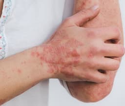 psoriasis