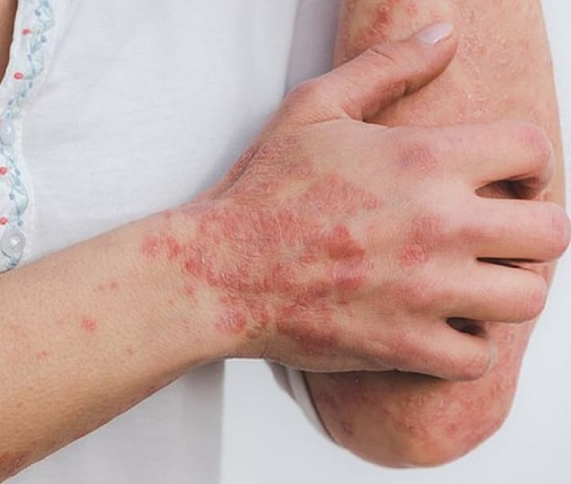 psoriasis