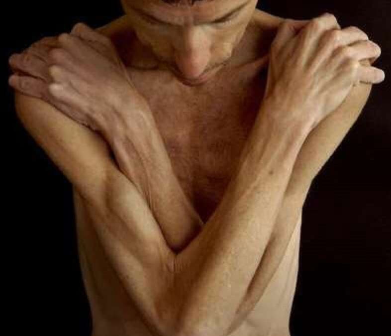 Anorexia