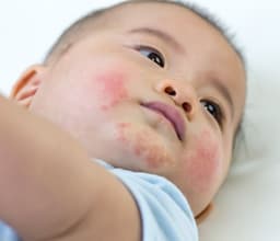 allergic reaction